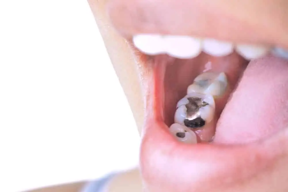Amalgam